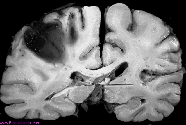 Lobar hemorrhage secondary to ru